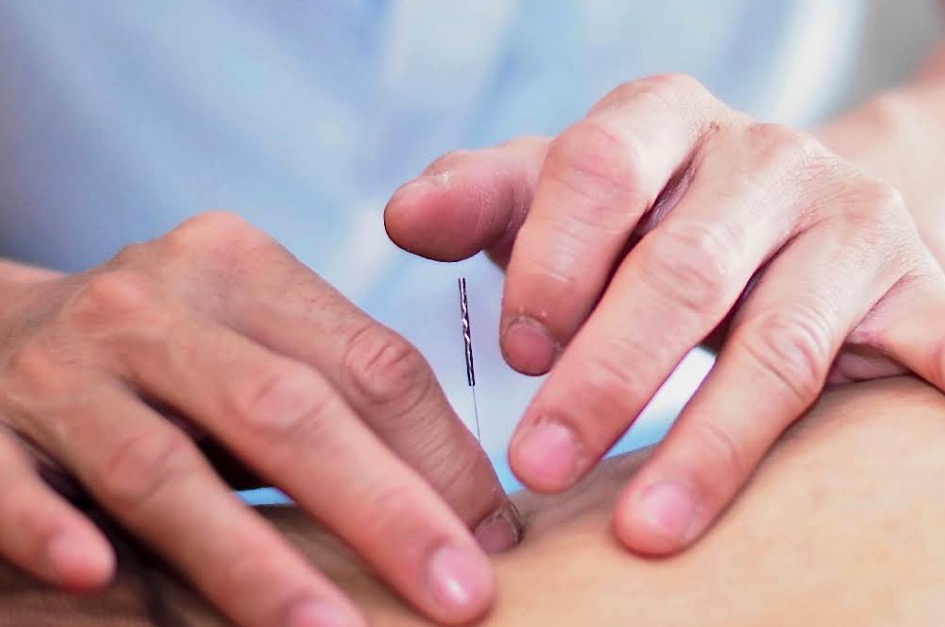 オススメの鍼灸！